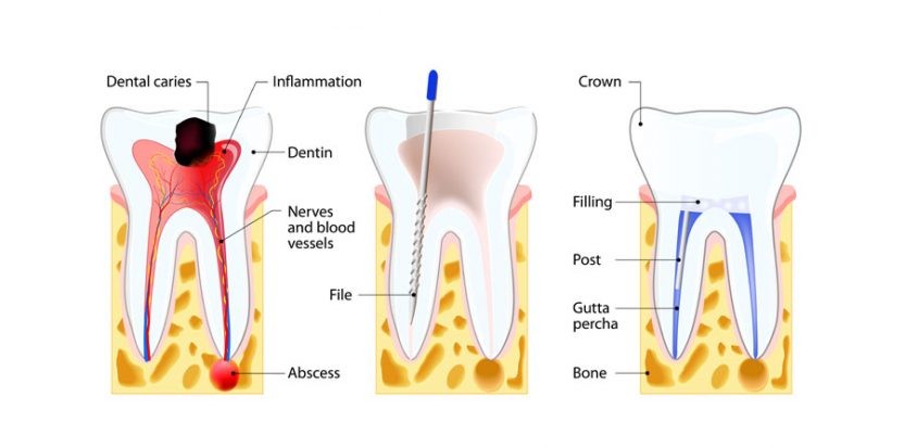 پس از عصب‌کشی دندان چه مراقبت‌هایی باید انجام دهیم؟